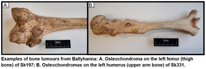 Photograph of two bones with tumours from Ballyhanna graveyard, County Donegal